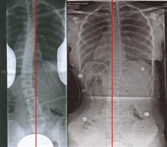 Сколиоз: до лечения и после (рентген)